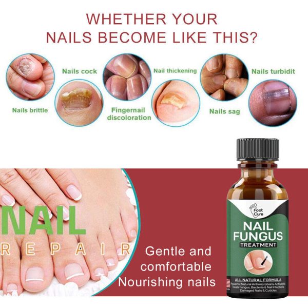 Nail Fungus Solution